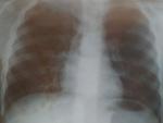 Рентген лёгких ребёнок 6 лет фото 4