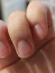 Розовая полоска на ногте, может оказаться подногтевая меланома? фото 2
