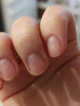 Розовая полоска на ногте, может оказаться подногтевая меланома? фото 1