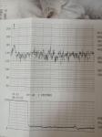КТГ расшифровка на 38 неделе беременности фото 1