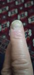 Грибковое заболевание ногтей и кожи фото 2
