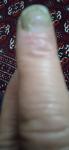 Грибковое заболевание ногтей и кожи фото 1
