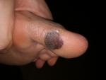 Коричневое пятно на пальце ноги фото 1