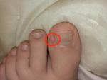 Воспаление возле ногтевой пластины большого пальца ноги фото 1