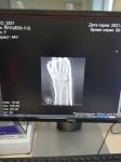 Перелом лучевой кости левой руки фото 1