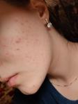 Как бороться с воспалениями на лице? фото 2