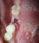 Боль после удаления зуба 8 дней фото 1