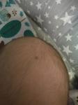 Родимое пятно у новорожденного фото 1