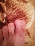 Воспаление на пальце ноги фото 1