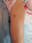 Синяки на ногах у ребёнка дочь 7 лет фото 1