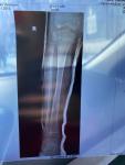 Перелом ноги большой берцовой фото 2