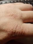 Шелушения кожи рук фото 1