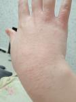 Сыпь на тыльной стороне руки, из-за сыпи отёк на пальцах фото 1