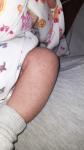 Сыпь у новорождённого ребёнка фото 1