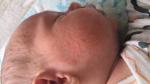 Аллергия или сыпь новорожденных фото 1