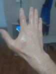 Аллергия на руках пятна и зуд фото 2