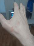 Аллергия на руках пятна и зуд фото 1