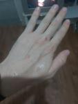 Аллергия на руках пятна и зуд фото 3