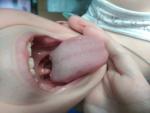 У ребенка шишки на корне языка фото 2