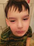 Аллергия на холод у ребенка 6 лет? фото 2
