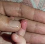 Красная шишка на пальце руки ребенка фото 2