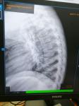 Компрессионный перелом позвоночника грудного отдела спины у ребёнка 4ех лет фото 2