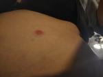 Red spot with a white head and painful фото 3