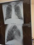 Рентген лёгких. Пневмания фото 1