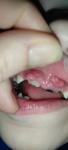 Зуб вне зубного ряда фото 3