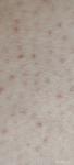Краснота, увеличение количества бугорков, сухость кожи при фолликулярном кератозе фото 1