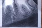 Болит зуб при нажатии фото 2