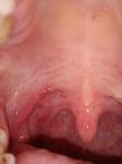 Разрастание лимфоидной ткани в горле фото 3