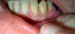 Трещина на десне возле поврежденного зуба фото 5