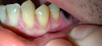 Трещина на десне возле поврежденного зуба фото 4