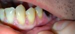 Трещина на десне возле поврежденного зуба фото 3