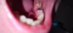 Трещина на десне возле поврежденного зуба фото 2