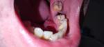 Трещина на десне возле поврежденного зуба фото 1