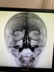 Подозрение на гайморит, боли в голове фото 2
