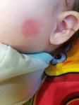 Аллергия(пятна на щеке) или нет? фото 3