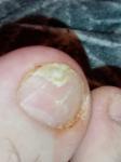 Грибок ногтя ноги фото 1