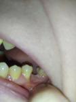 Оголение шейки зуба фото 1