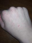 Красные пятна на руке, без симптомов фото 1