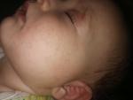 Мелкая сыпь на лице и теле у ребенка фото 1
