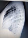 Рентген лёгких фото 2