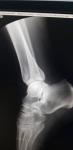 Перелом ноги большеберцовой кости фото 3