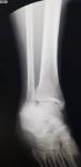 Перелом ноги большеберцовой кости фото 2