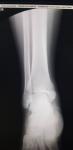Перелом ноги большеберцовой кости фото 1