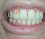 Точка на внешней части переднего зуба фото 3