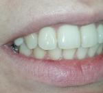 Точка на внешней части переднего зуба фото 2