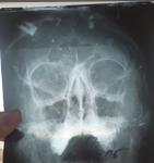 Заложен нос, искривлена перегородка, рентгеновский снимок не понятенй фото 1